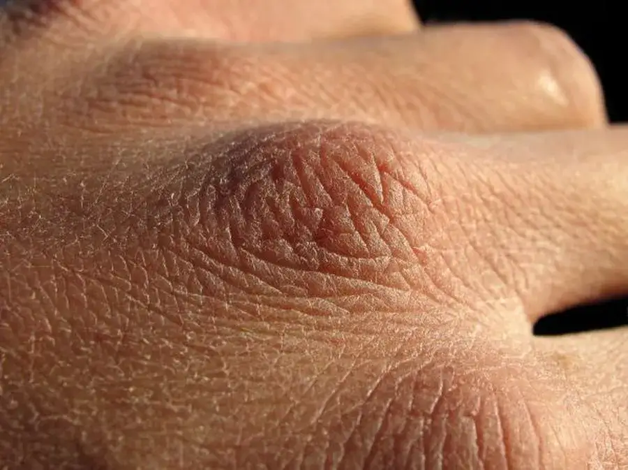 Niepokojące objawy skórne nadczynności przytarczyc: co musisz wiedzieć