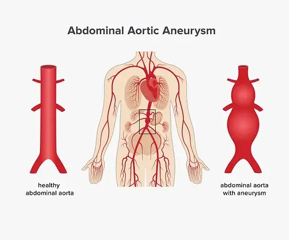 Aneurysma Symptome Bauch: Warnsignale, die Sie nicht ignorieren sollten