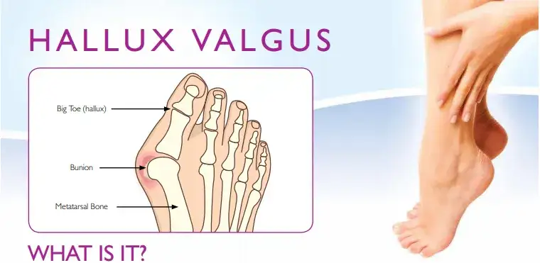 Do jakiego lekarza z haluksami? Ortopeda, podolog, fizjoterapeuta