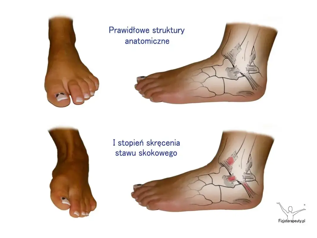 Skręcenie: Jak rozpoznać uraz, udzielić pomocy i wrócić do formy?