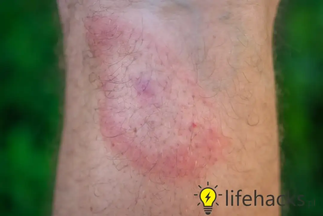 Kleszcze pod skórą? Fakty, usuwanie i objawy chorób