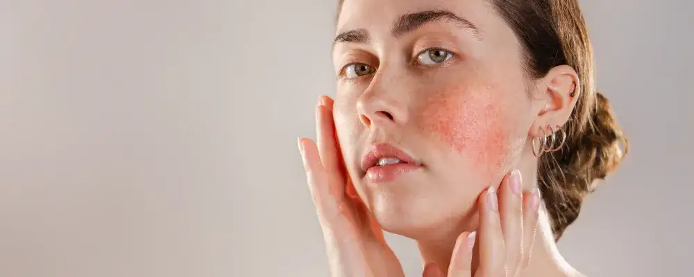 Jaki krem do cery naczynkowej? Odkryj skuteczne składniki i porady