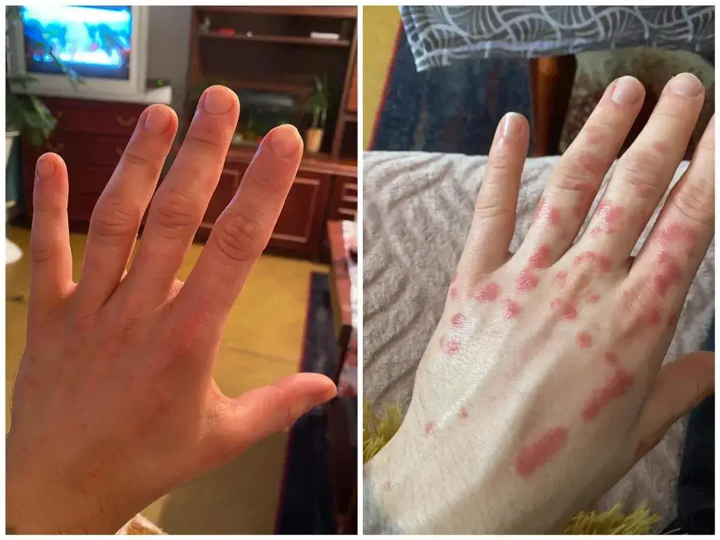 Czy na łuszczycę można dostać rentę? Sprawdź warunki i możliwości