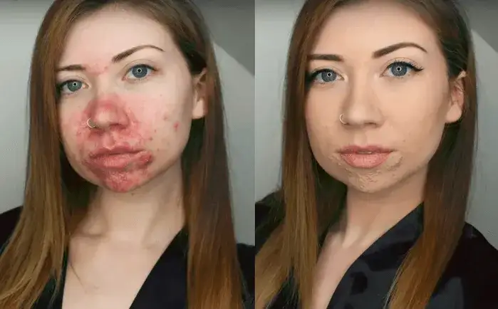 Jak ukryć pryszcze makijażem - skuteczne sposoby na naturalny efekt