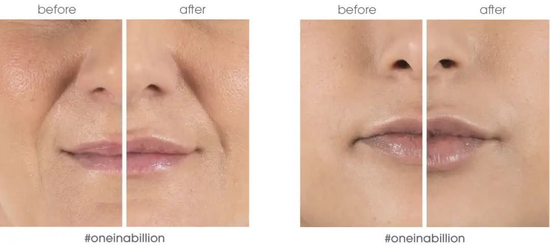 Nawilżanie ust kwasem hialuronowym: Pełne, miękkie usta bez powiększania?