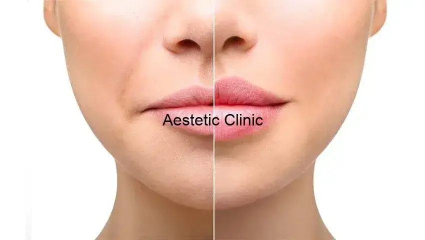 Laserowe powiększanie ust: Efekt na 6-12 miesięcy? Jak go przedłużyć?