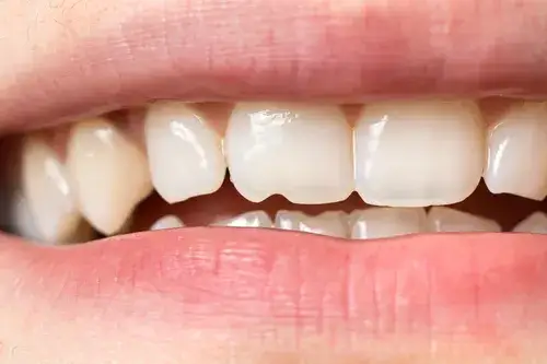 Dlaczego zęby się kruszą? Odkryj przyczyny i jak temu zapobiec