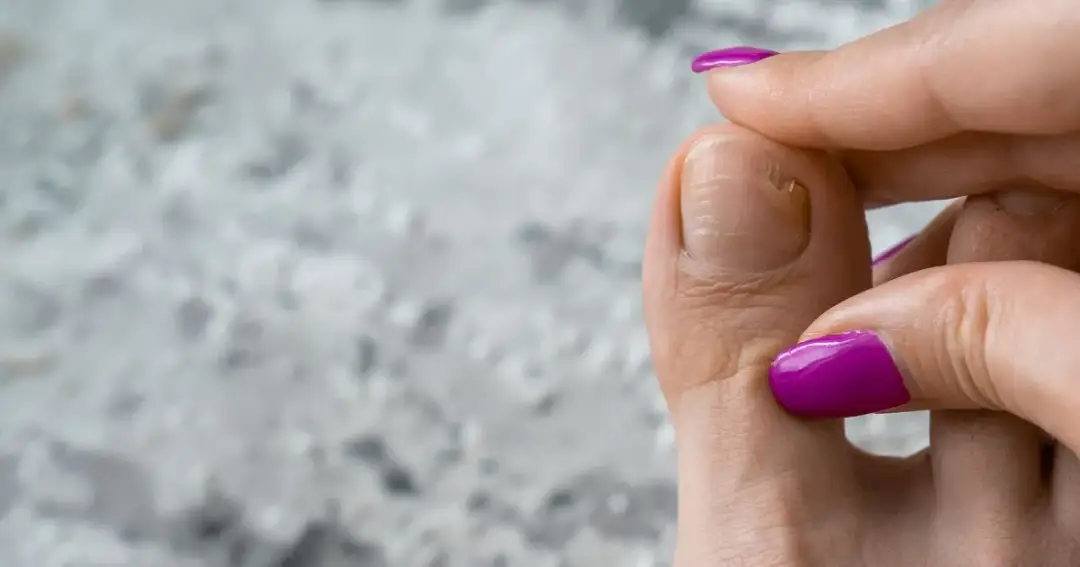 Jak skutecznie zabezpieczyć wolny brzeg paznokcia i uniknąć jego uszkodzeń