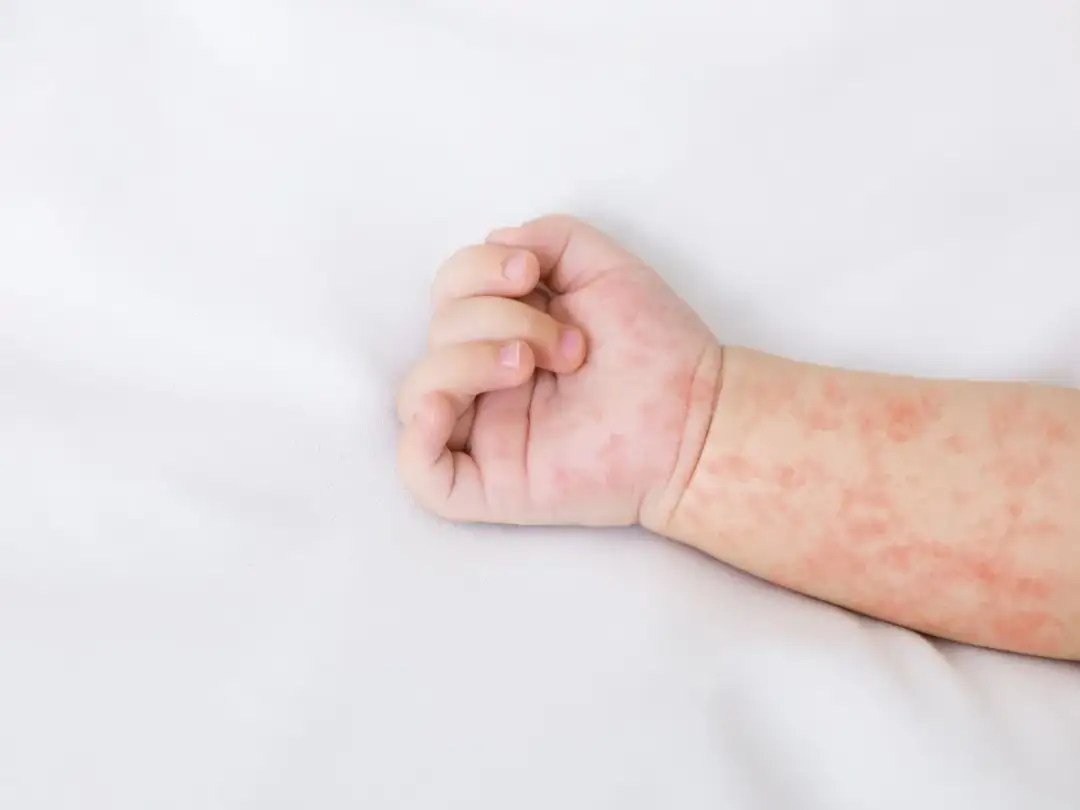 Jak wygląda uczulenie na proszek u niemowlaka? Objawy i rady