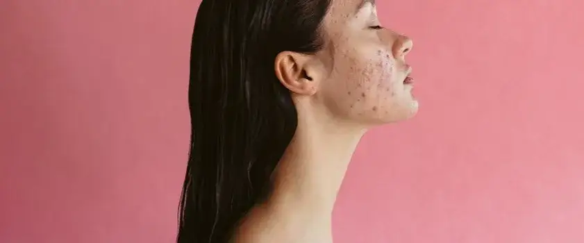 Jak szybko zmniejszyć zaczerwienienie pryszcza? Sprawdzone sposoby