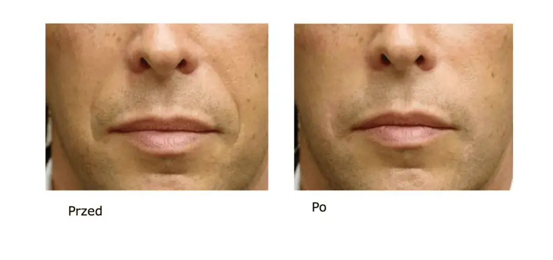 Kwas hialuronowy ile się utrzymuje – jak długo cieszyć się efektami?