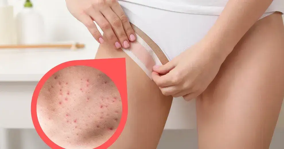 Jak pozbyć się krostek po goleniu bikini i cieszyć się gładką skórą