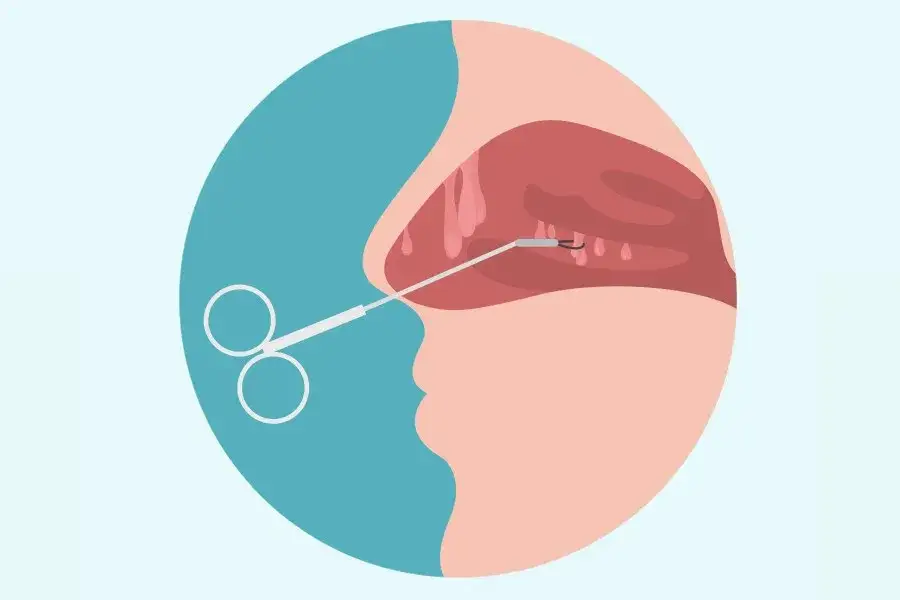 Ropa z nosa: przyczyny, objawy i skuteczne metody leczenia