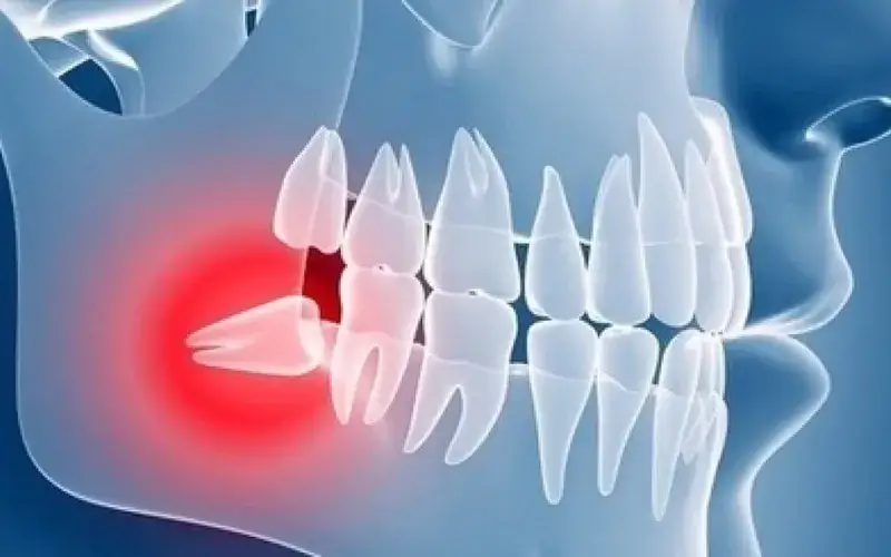 Dlaczego ósemki to zęby mądrości i co to oznacza dla zdrowia?