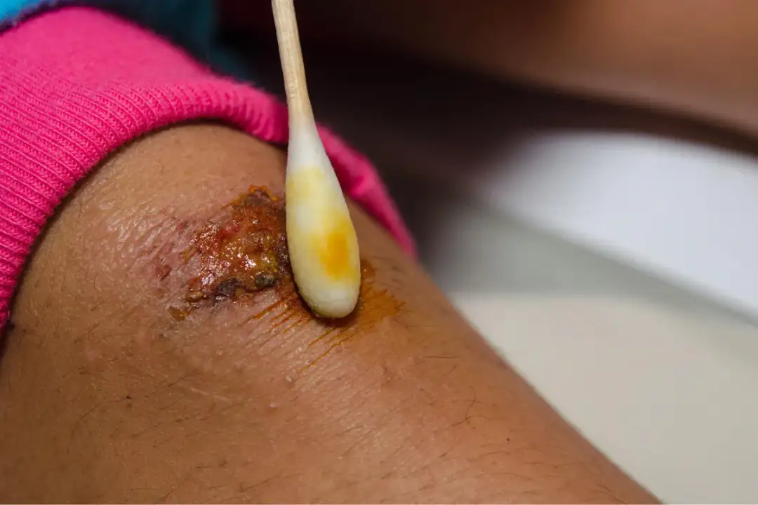 Jak przyspieszyć gojenie rany po pryszczu i uniknąć blizn