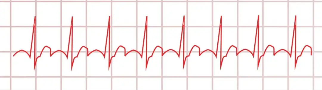Myokarditis Diagnostik EKG: EKG-Befunde verstehen und richtig deuten