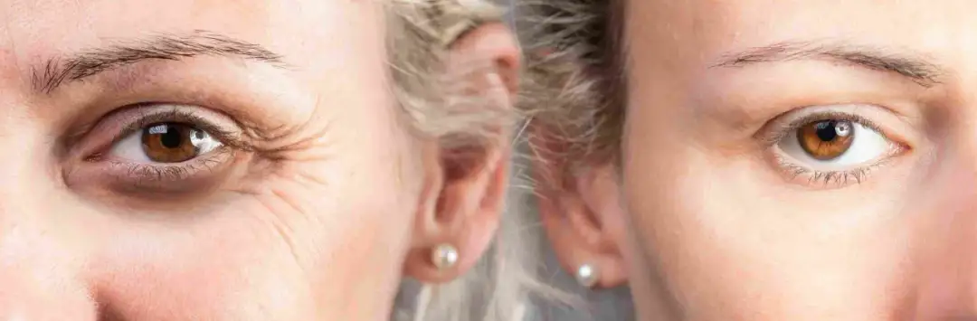 Co to jest botoks? Poznaj skutki i zastosowanie w medycynie estetycznej