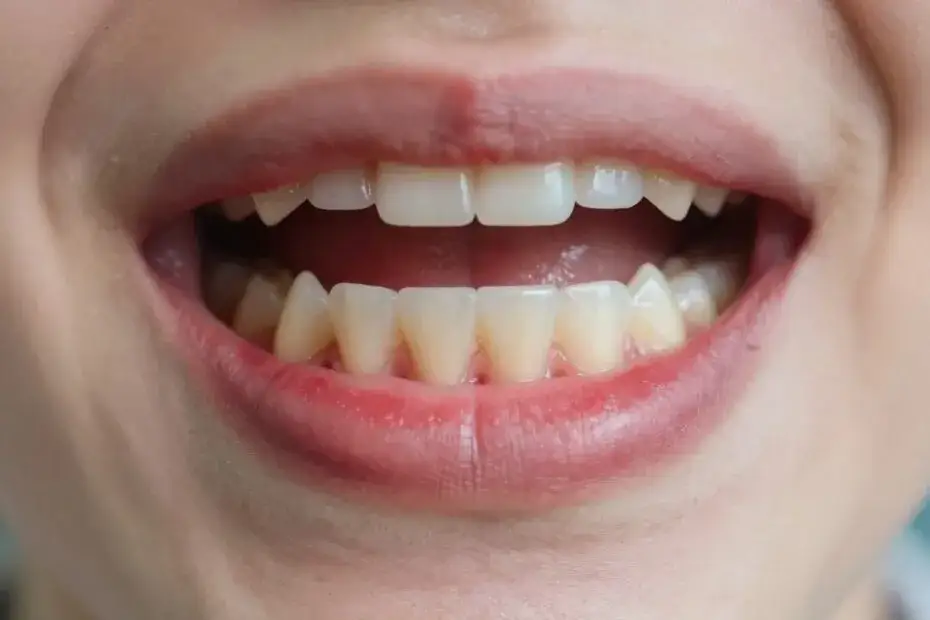 Zapalenie dziąseł: Rozpoznaj i wylecz, zanim będzie za późno