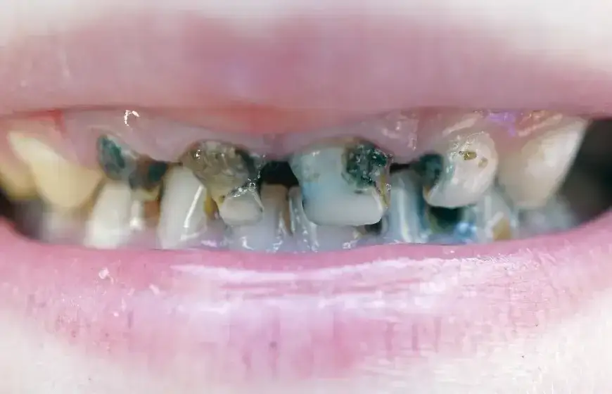 Jak wygląda próchnica zęba? Rozpoznaj ją od plamy do dziury!