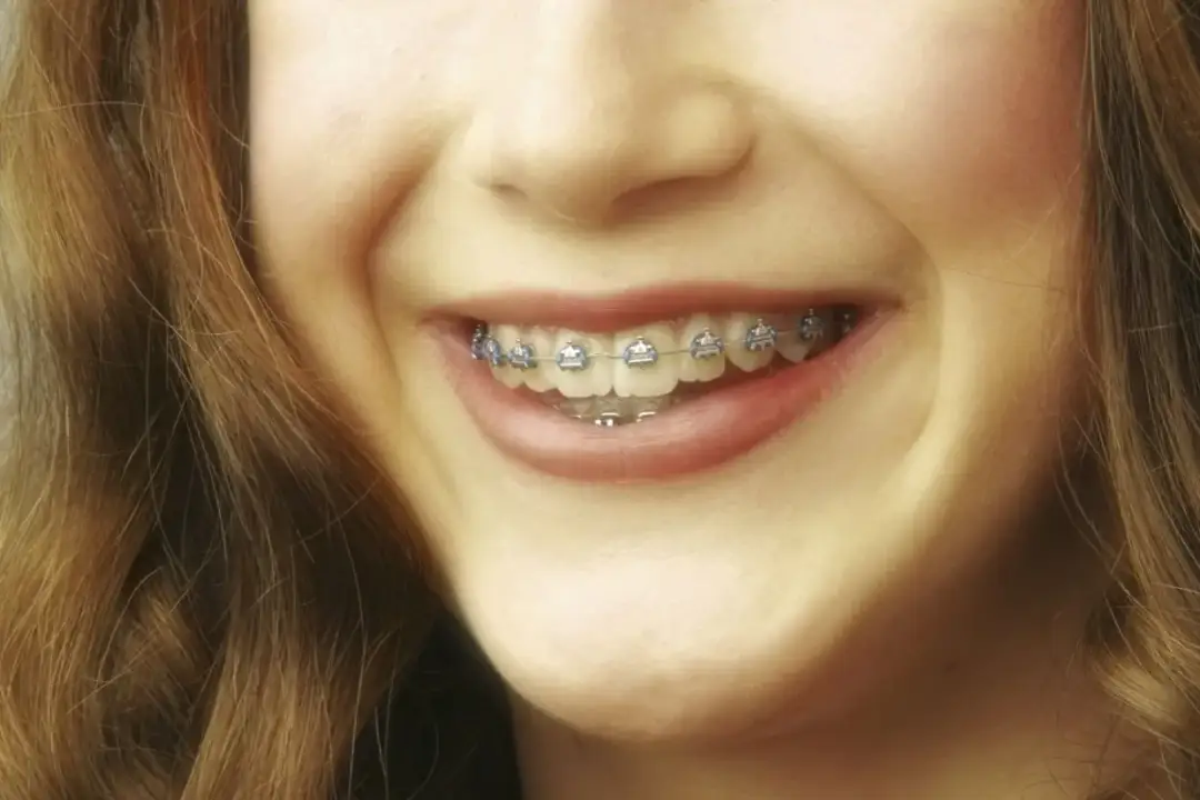 Czy aparat na zęby powiększa usta? Odkryj subtelne zmiany w wyglądzie