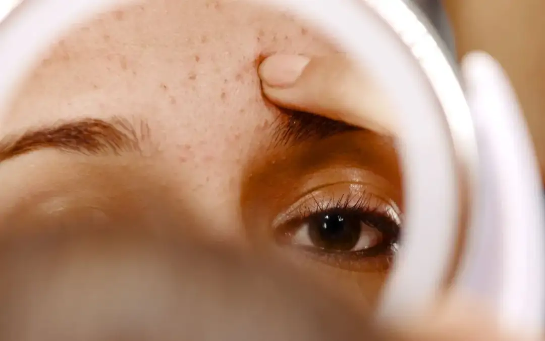 Jak zakryć pryszcze: skuteczne triki na idealną cerę bez blizn