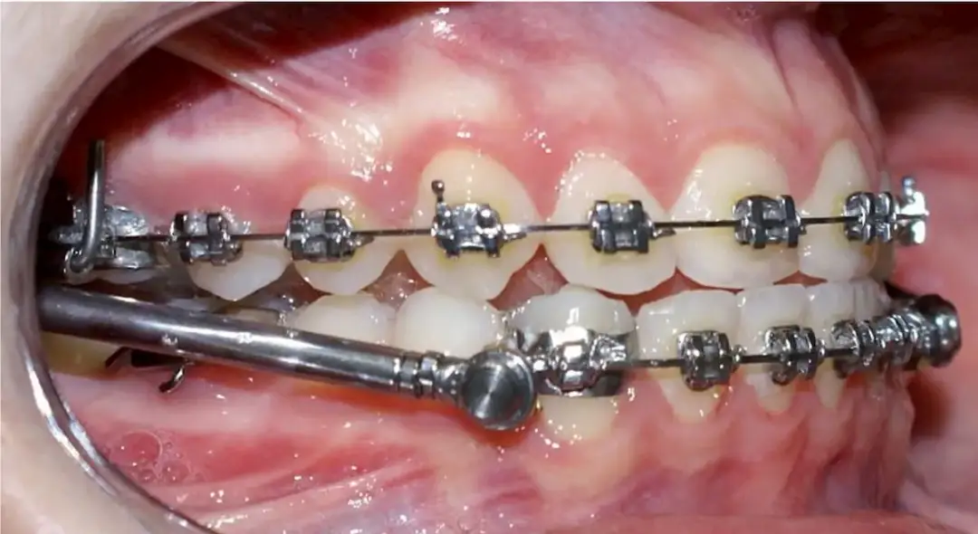 Skuteczne sposoby na ból zębów przez aparat ortodontyczny