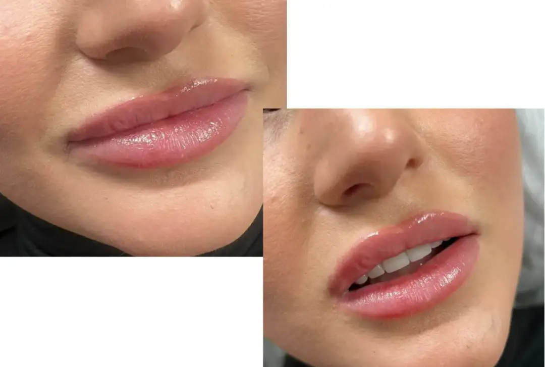 Najlepsze miejsca na powiększanie ust w Szczecinie - wybierz mądrze