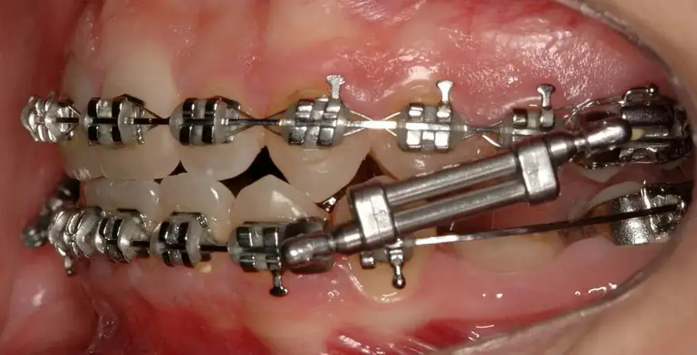 Dofinansowania na aparat ortodontyczny – jakie masz możliwości?