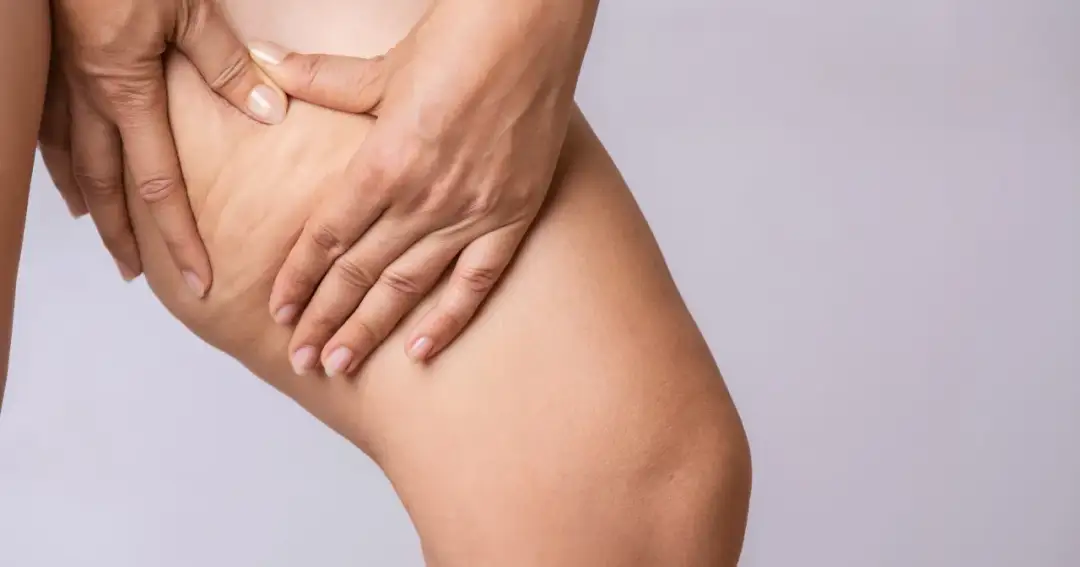 Jak pozbyłam się cellulitu? Moja historia i skuteczne metody