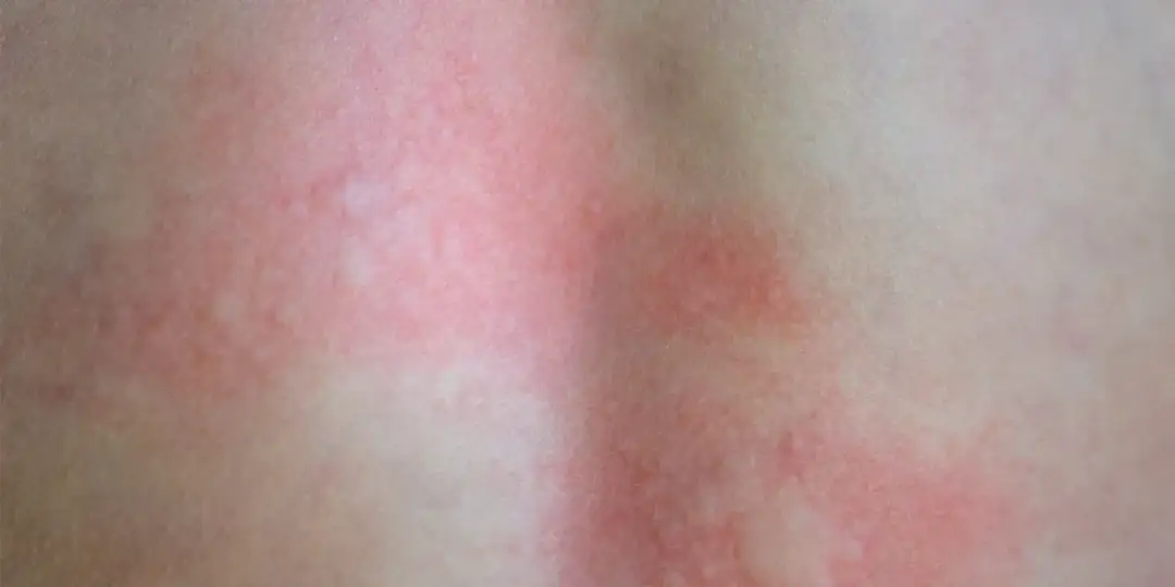 Czerwona, swędząca wysypka na skórze, która może być oznaką reakcji alergicznej lub jak wygląda obrzęk po kleszczu.