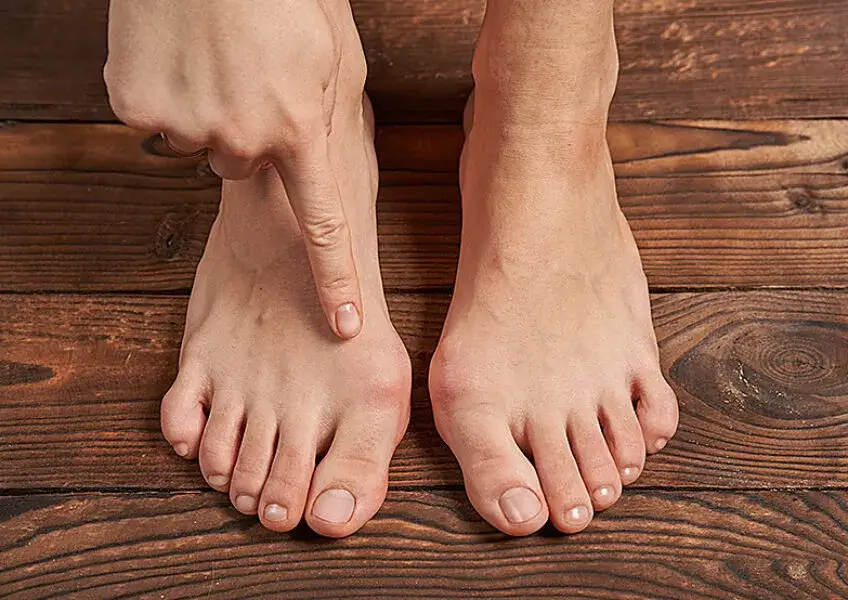 Paluch koślawy: Co to jest i jak skutecznie leczyć haluksy?