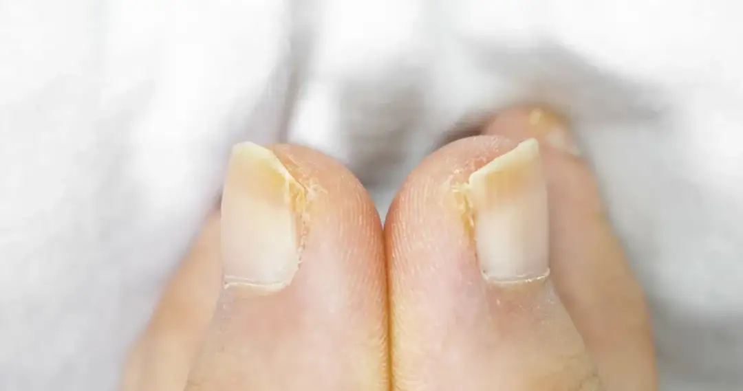 Sennik Paznokcie u Nóg: Pomalowane, Malowanie, Złamany, Odpadający