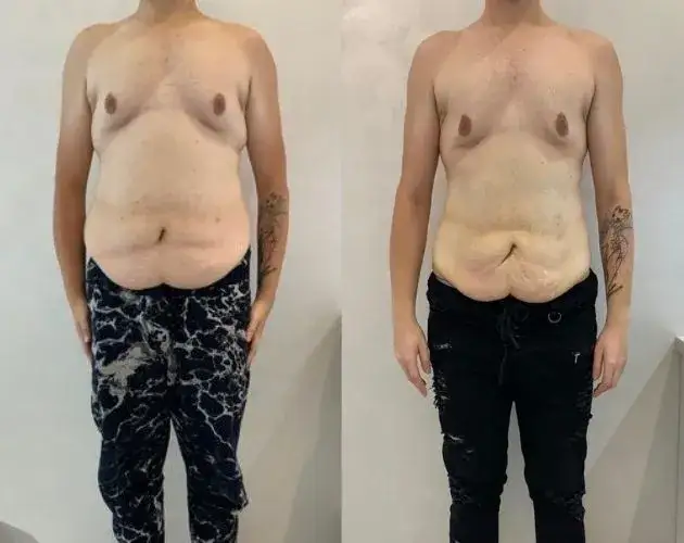 Redukcja tkanki tłuszczowej