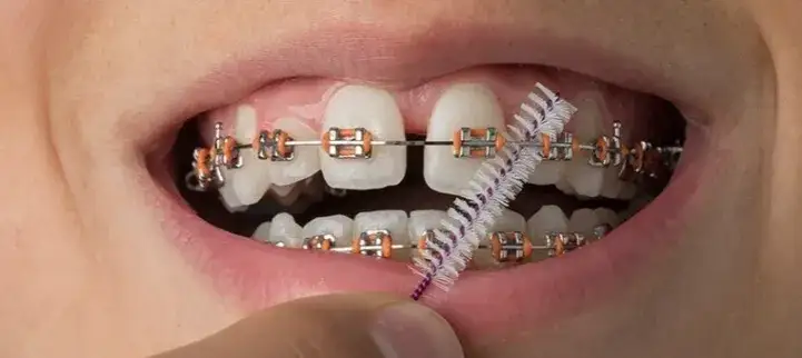 Skuteczne sposoby na ból zębów przez aparat ortodontyczny