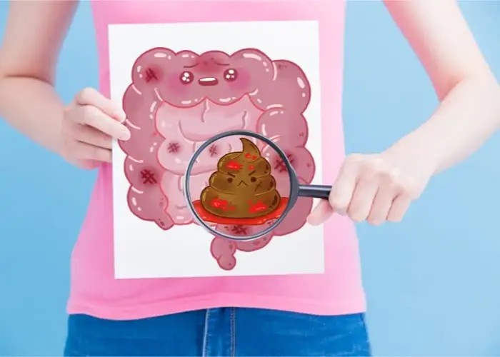 Krew utajona w kale: dlaczego jest ważna i jak ją diagnozować?