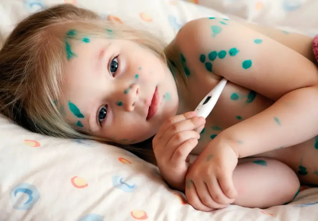 Ospa w przedszkolu co robić: kluczowe kroki dla rodziców