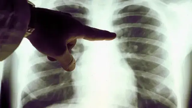 Quién descubrió el linfoma no Hodgkin y su historia sorprendente