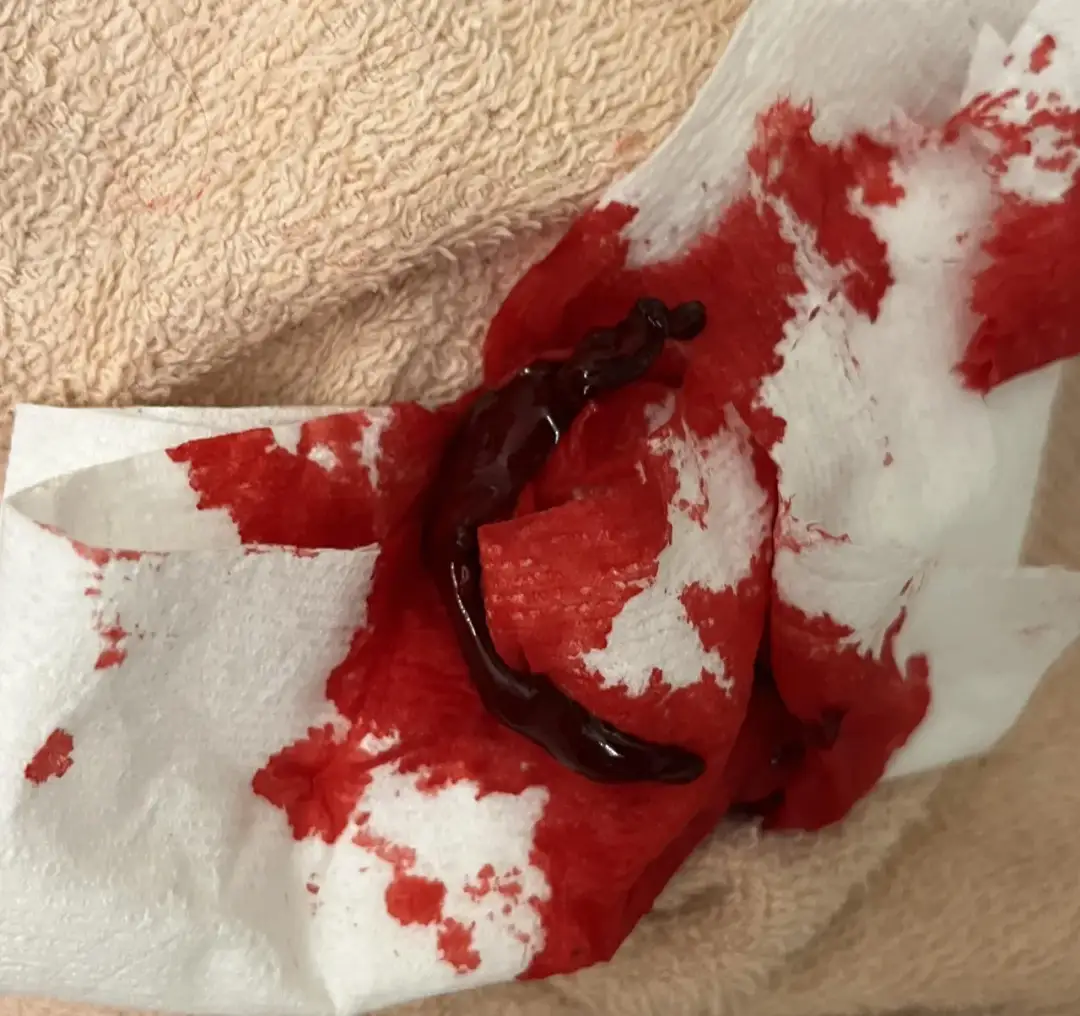 Jak długo utrzymują się skrzepy po porodzie? Ważne informacje dla zdrowia