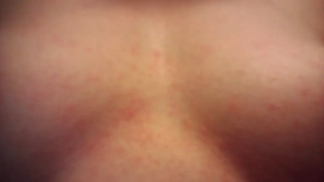 Wysypka między piersiami objawy: co może oznaczać i jak leczyć