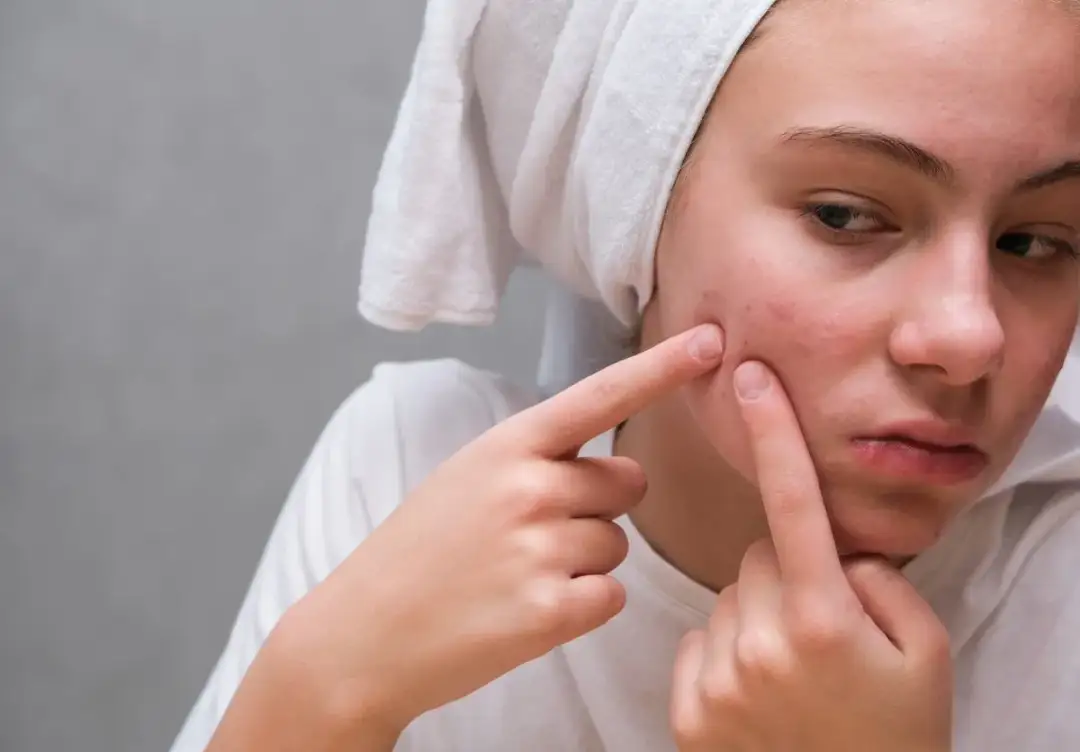 Pryszcz przed ważnym wyjściem? Pozbądź się go w kilka godzin!