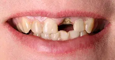 Ile kosztuje odbudowa złamanego zęba? Poznaj ceny i metody