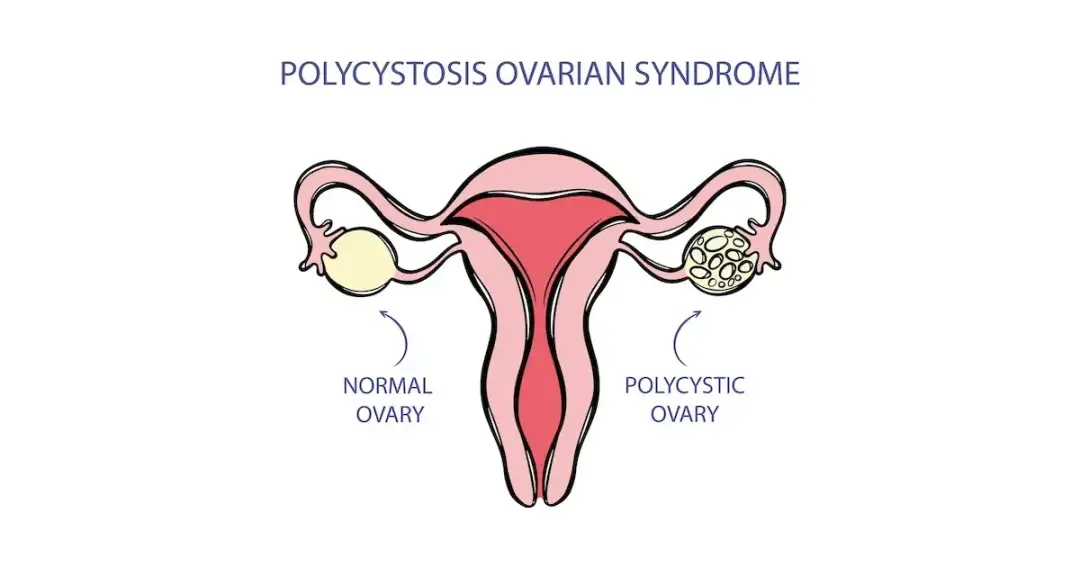 PCOS: jakie badania krwi są kluczowe dla diagnozy i zdrowia jajników?