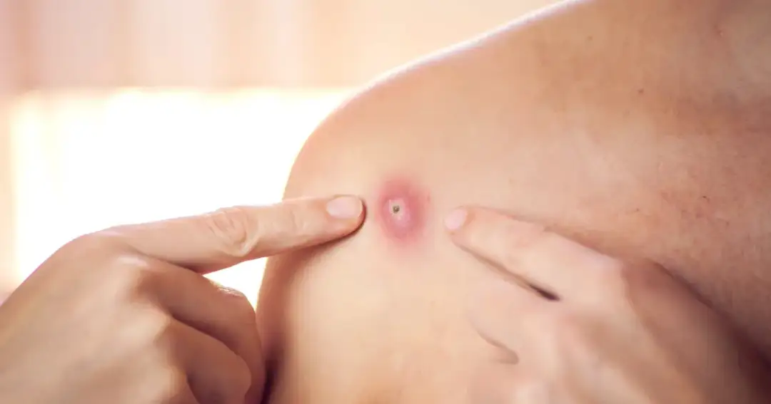 Co to jest pryszcz? Przyczyny, objawy i skuteczne metody leczenia