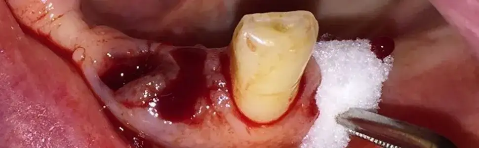 Krwawienie po wyrwaniu zęba: Czy to normalne? Poradnik eksperta