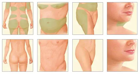 Ile kosztuje liposukcja ud? Poznaj ceny i ukryte wydatki