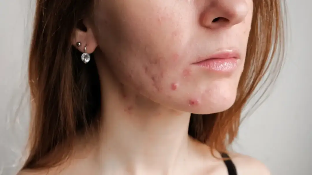 Skuteczne sposoby na pryszcze: Poradnik, który działa