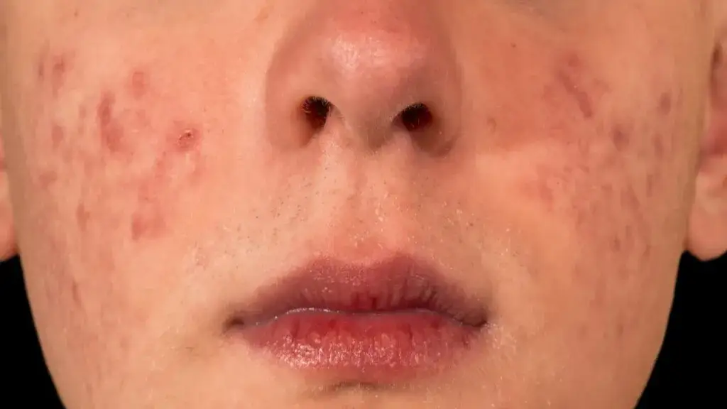 Skuteczne sposoby na wybielanie czerwonych plam po pryszczach