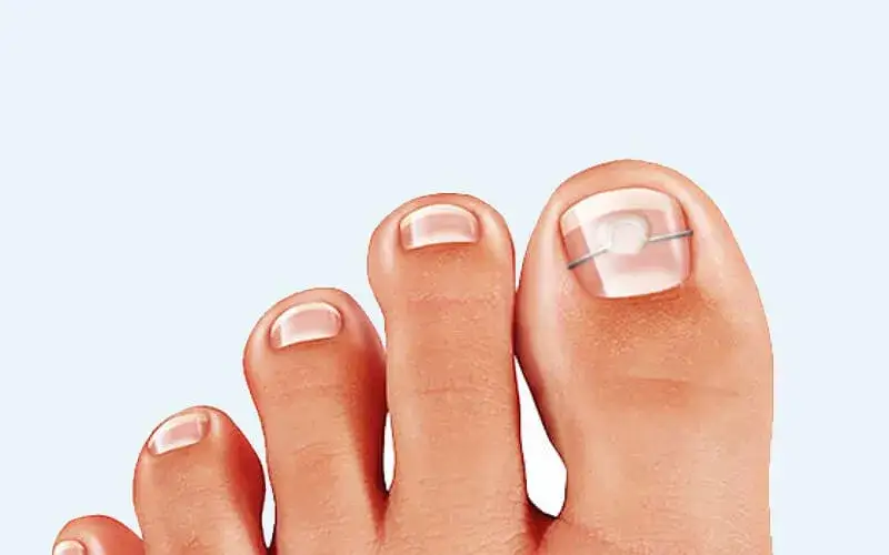 Jak skutecznie leczyć paznokcie rurkowate u nóg i uniknąć bólu