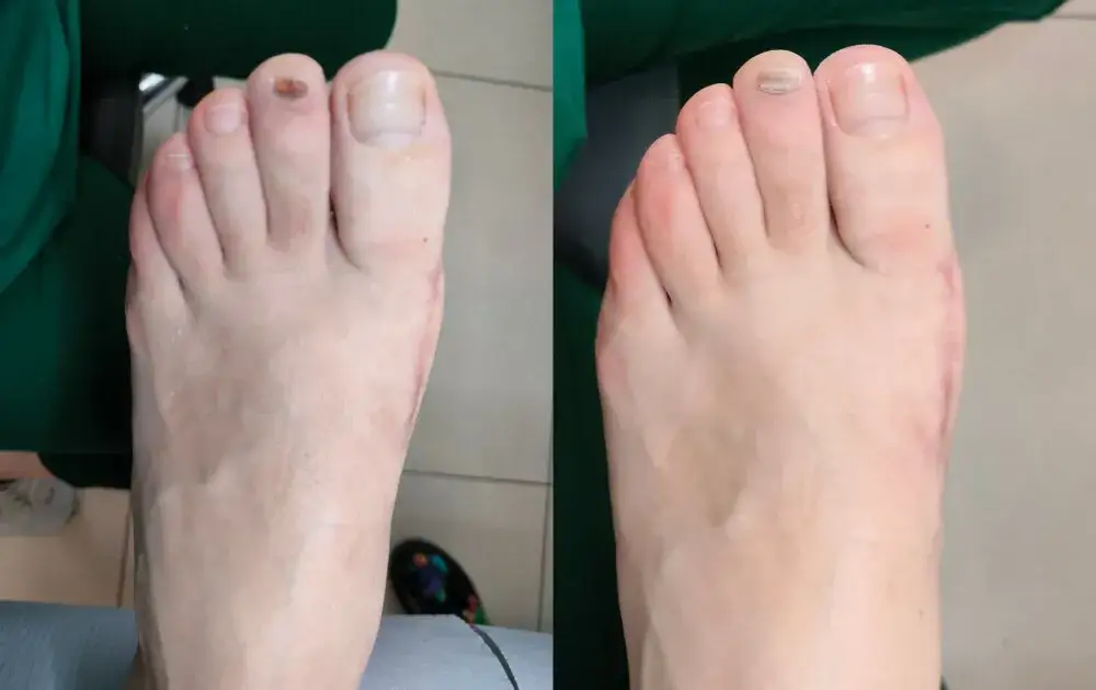 Jak pozbyć się krwiaka pod paznokciem: Skuteczne domowe sposoby