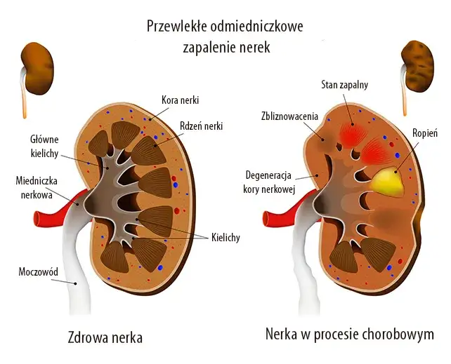 Choroba nerek: Co dzieje się z Twoim umysłem? Objawy i pomoc